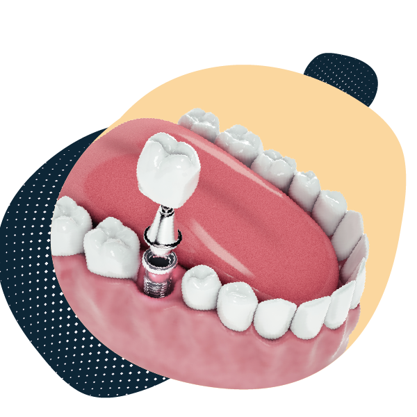 Affordable Dental Implants